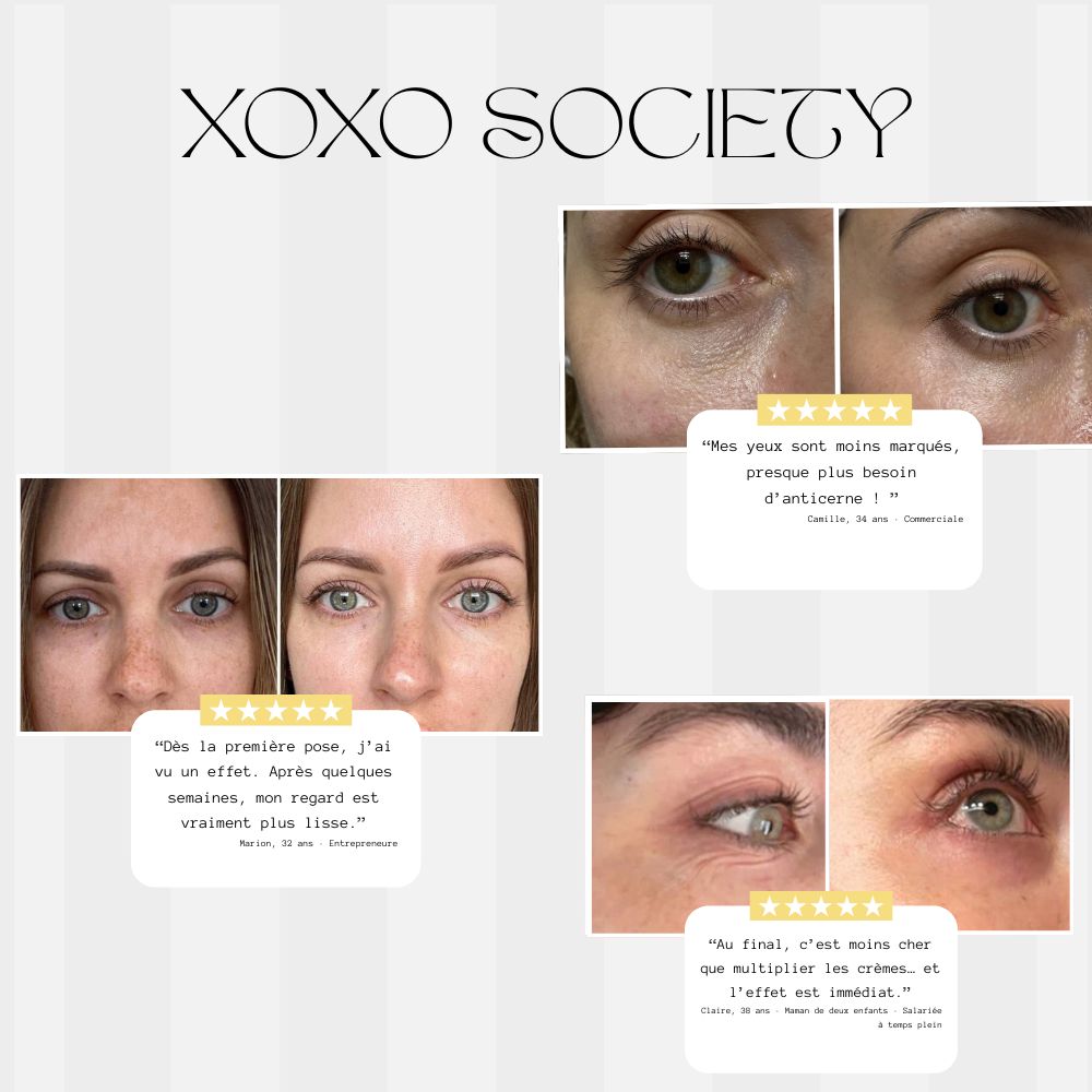 Patch Microneedle Acide Hyaluronique & Collagène – Soin Lissant Ridules et Cernes