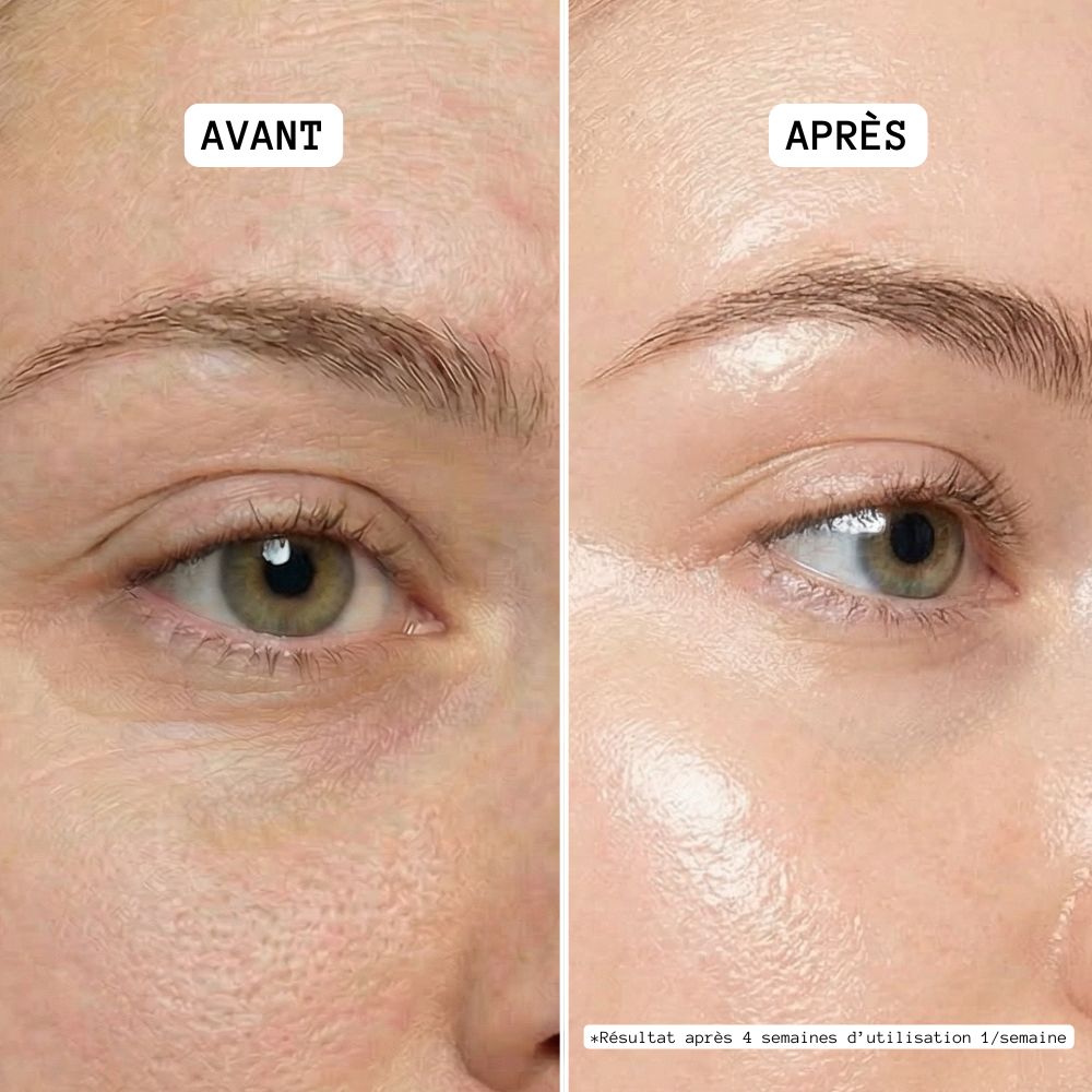 Patch Microneedle Acide Hyaluronique & Collagène – Soin Lissant Ridules et Cernes