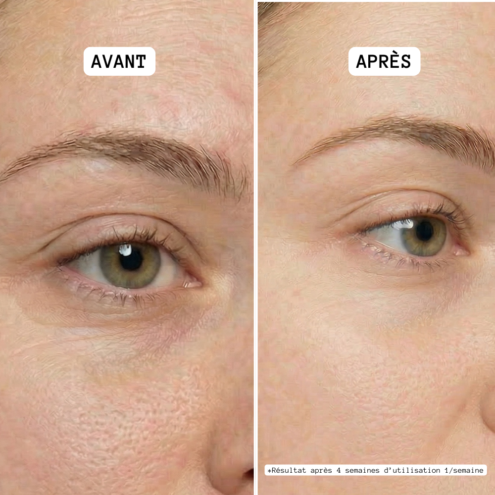XOXO Perfect Eyes : Patchs yeux microneedle à l'acide hyaluronique et au collagène